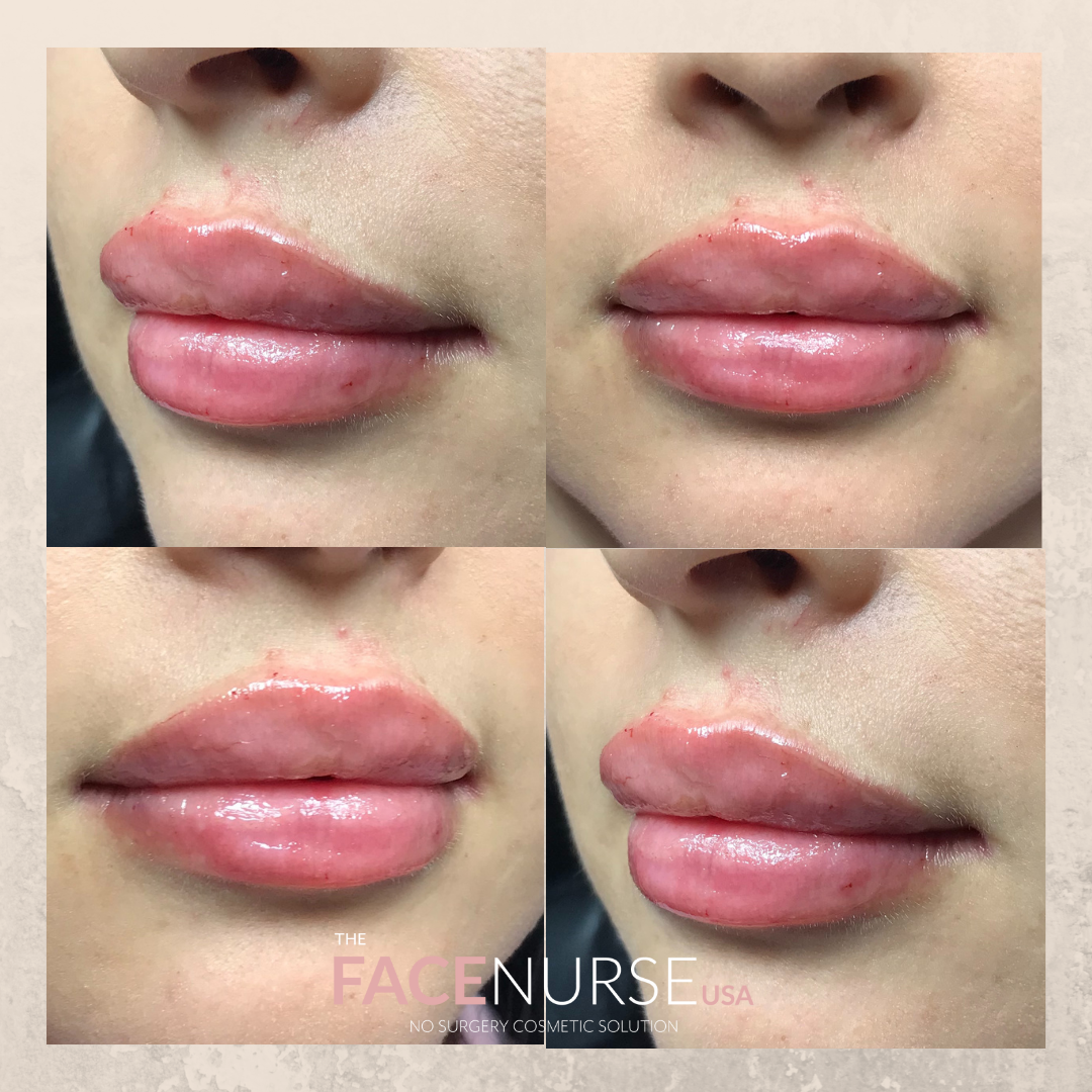LIP AUGMENTATION