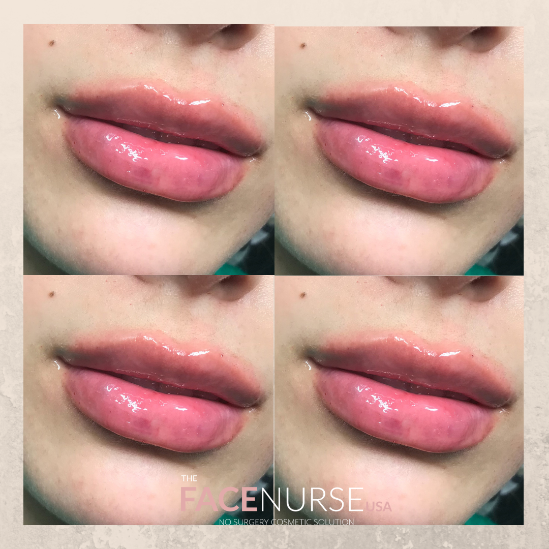 LIP AUGMENTATION