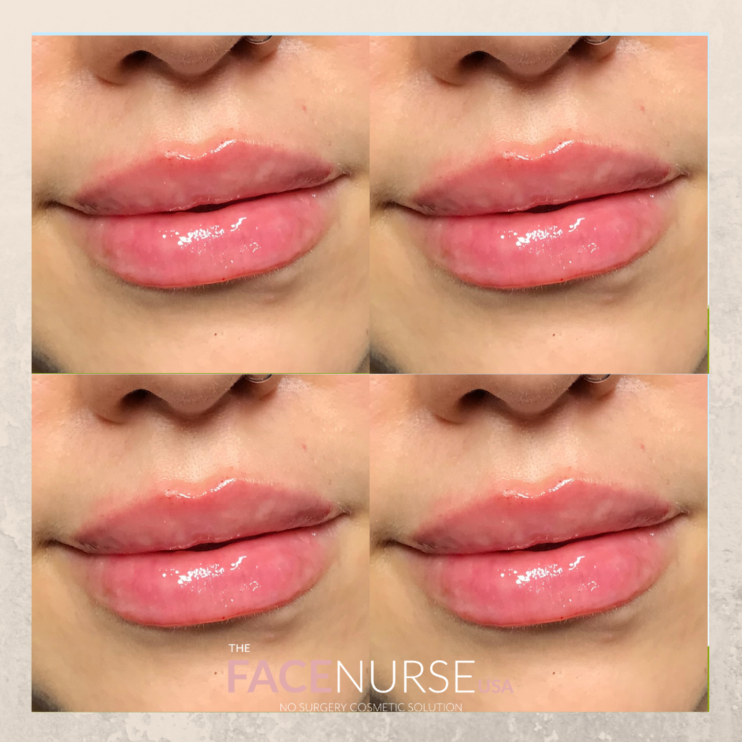 LIP AUGMENTATION