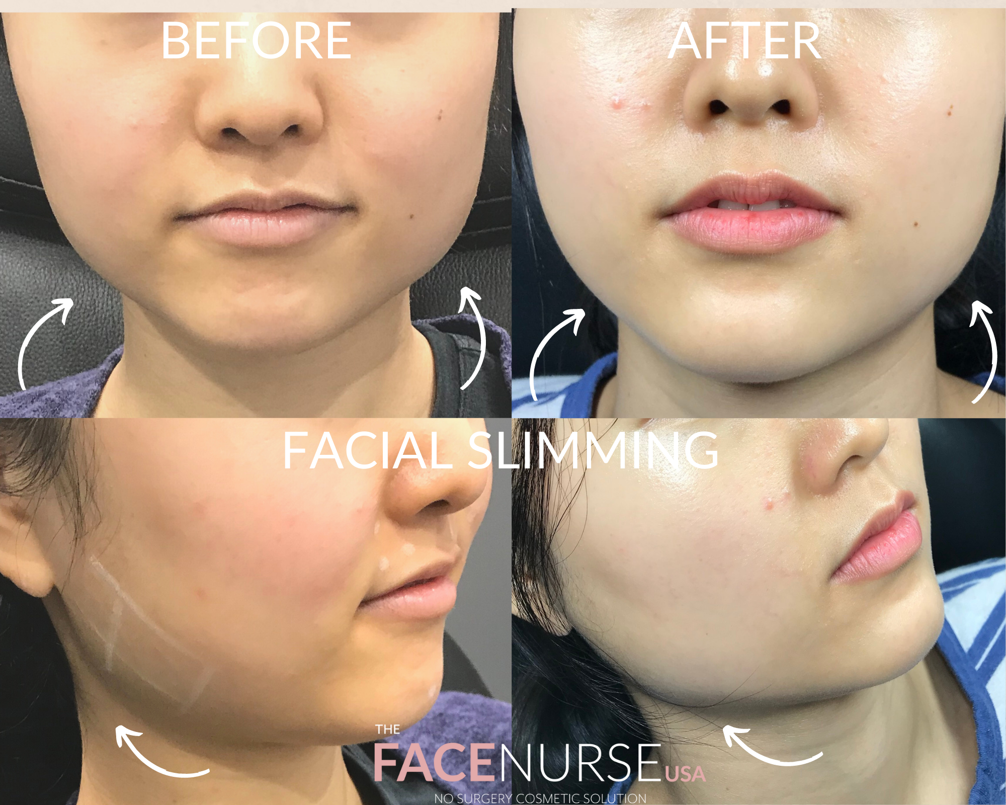 FACIAL SLIMMING