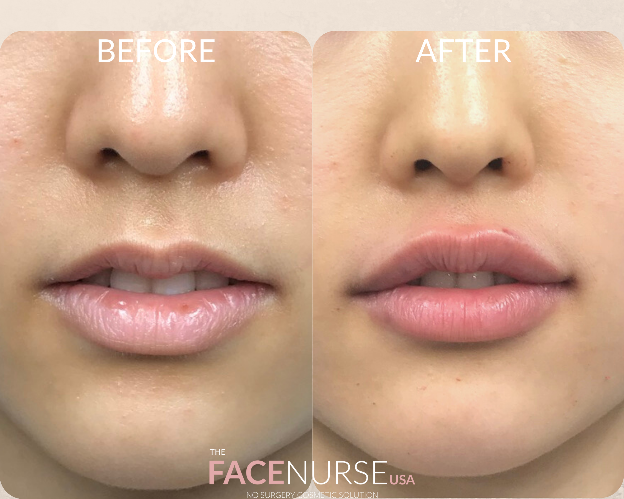 LIP AUGMENTATION