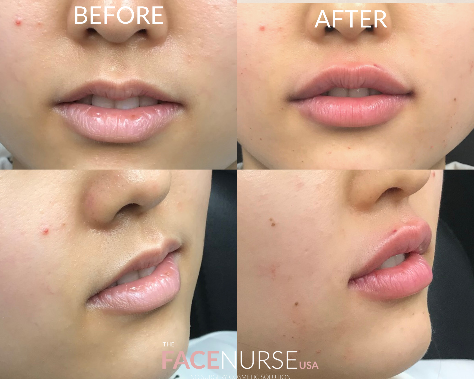 LIP AUGMENTATION
