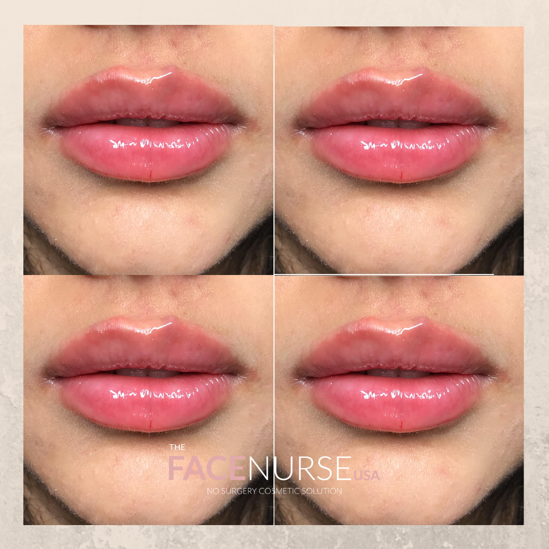LIP AUGMENTATION