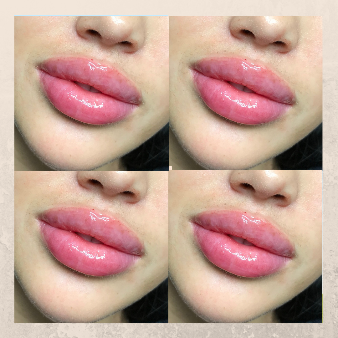 LIP AUGMENTATION